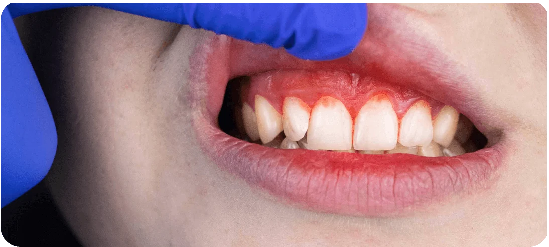 3D-image-of-a-single-implant-in-lower-jawbone 2 (1) (1)