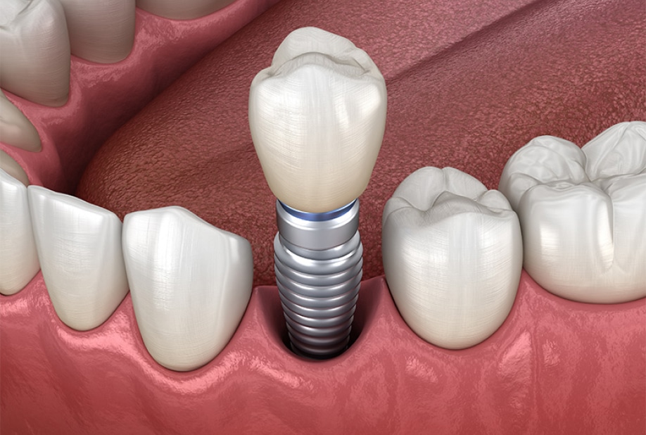 multipal_teeth_dental_image