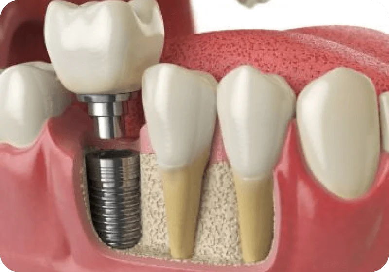 3D illustration of a dental implant beside natural teeth
